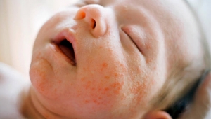 Bebeklerde görülen egzama tedavi edilmezse ne olur?