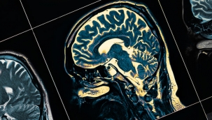 2040'a kadar Parkinson hastası sayısı 18 milyona ulaşabilir!