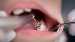 Düzenli egzersiz yapmak dişlerinizi çürümeden korur mu?