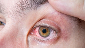 Göz yaşı kanal tıkanıklığı en çok bu kişilerde görülüyor!