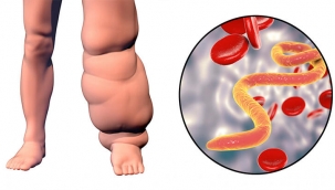 Lenf bezleri tıkanırsa bu hastalık ortaya çıkıyor! - Fil hastalığı (lenfödem) nedir?