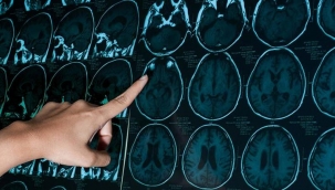 Corona virüs kanı pıhtılaştırıp felce yol açıyor!