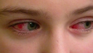 Göz nezlesi belirtileri ve tedavi yöntemleri: Göz nezlesi neden olur, nasıl geçer?