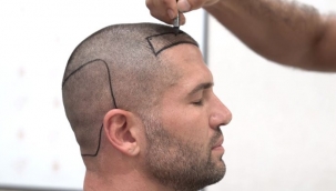 Saç ekimi sonuçları neye göre değişir? Saç ekimi sonuçları farklılık gösterir mi?