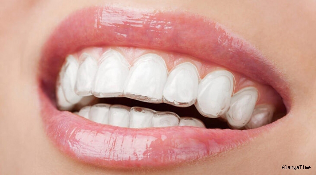 Diş teline alternatif yeni nesil teknoloji: Şeffaf plak