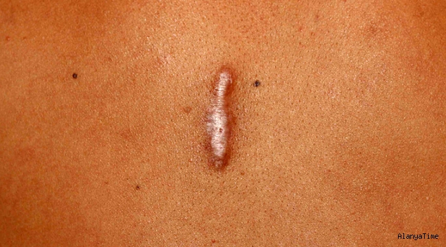 Keloid nedir?