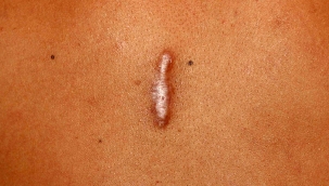 Keloid nedir?