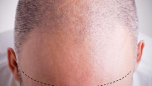 Pandemide estetik olarak en çok saç ekimi tercih edildi!