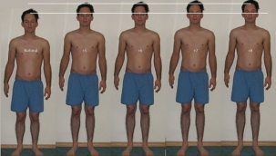 Boy uzatma ameliyatının riski var mıdır?