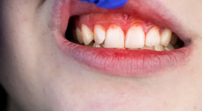 Diş eti hastalığı, yüksek tansiyona yol açabilir