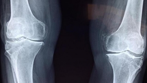 Bilim insanları şimdiye kadar yapılmış en iyi sentetik kıkırdağı geliştirdi