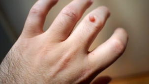 Siğiller için 10 doğal çözüm