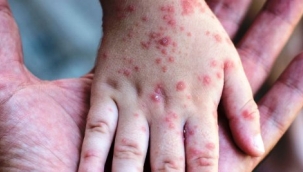 Dünya genelinde maymun çiçeği vaka sayısı 131'e yükseldi