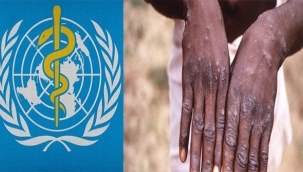 Dünya Sağlık Örgütü (DSÖ): Maymun çiçeği virüsünün yeni bir salgına dönmesini öngörmüyor