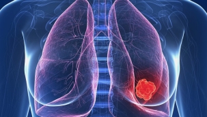 Akciğer kanserinde sigara dışında 7 risk faktörü