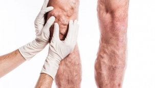 Venaseal yöntemi ile varislerinizden ameliyatsız kurtulun