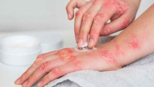 Uzmanı açıkladı: Uyuz nasıl geçer?