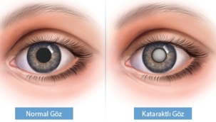 GÖZLERDEKİ SİS PERDESİ: KATARAKT