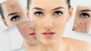 Dünya tarihinde bir ilk geliyor: Sivilce aşısı geliştirildi, 'Artık herkes pürüzsüz bir cilde sahip olabilecek'