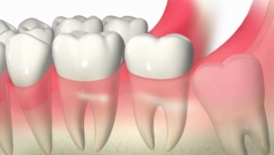 5 yıl içinde yeni bir diş çıkarmak mümkün olabilecek